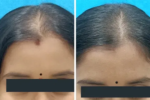 Hair rejuvation therapy before photo in VCare